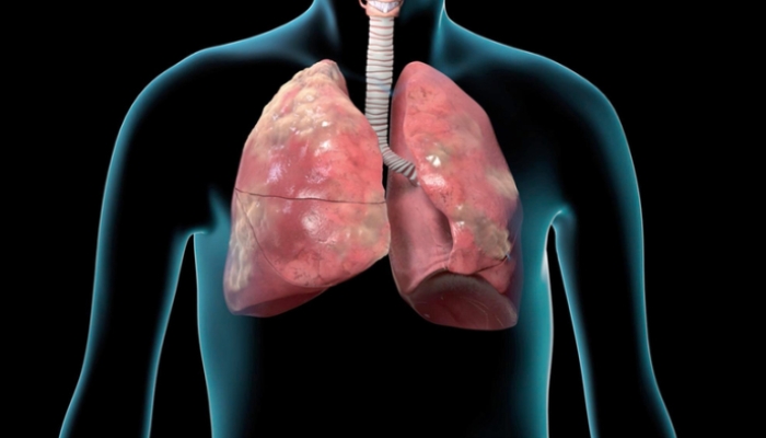 Memahami Rencana Perawatan COPD