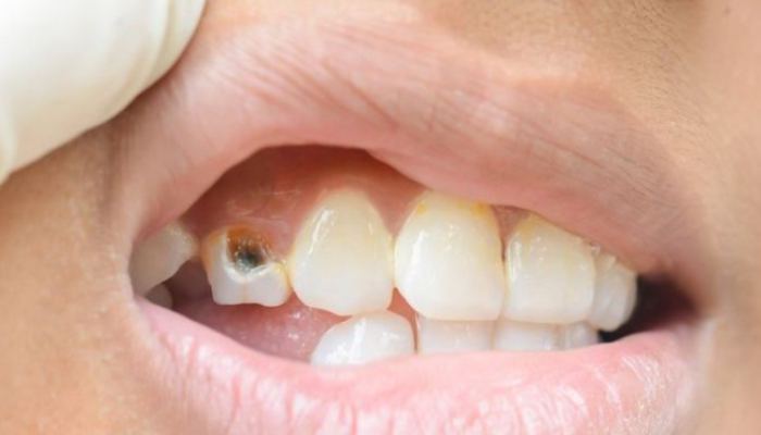 Fakta yang Harus Diketahui Tentang Penyebab Gigi Berlubang dan Karies